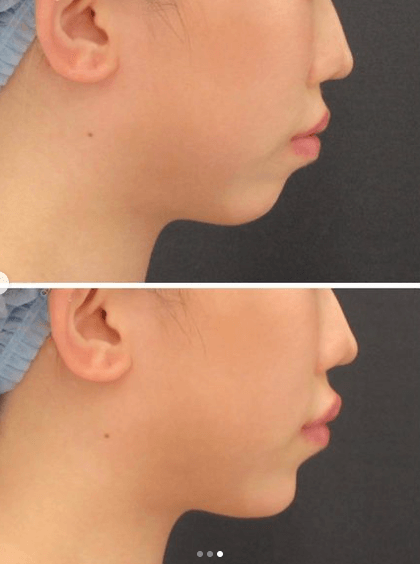 ヒアルロン酸注射の前後の唇画像
