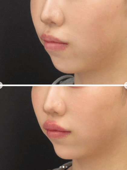 ヒアルロン酸注射の前後の唇画像